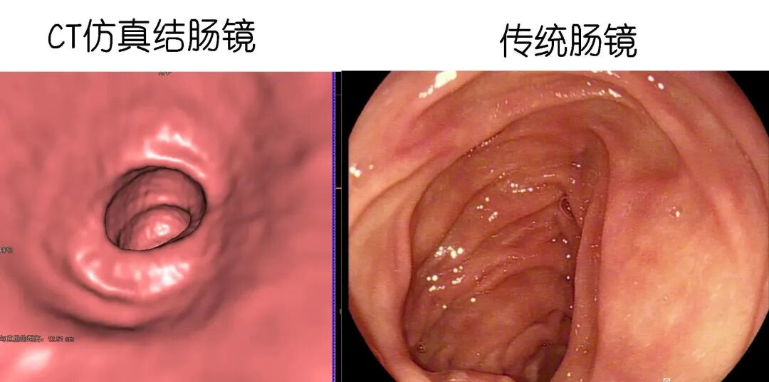 电子直肠镜怎么做CT也能做“肠镜”了！？ 不用插管！不用脱裤子_https://www.jmylbn.com_新闻资讯_第3张
