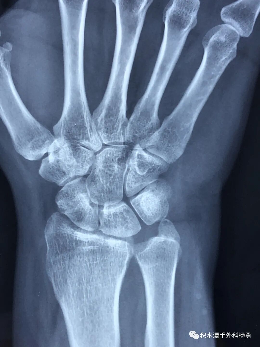 【科普文章】手腕疼痛,切莫大意,警惕"尺腕撞击综合征"! - 好大夫在线