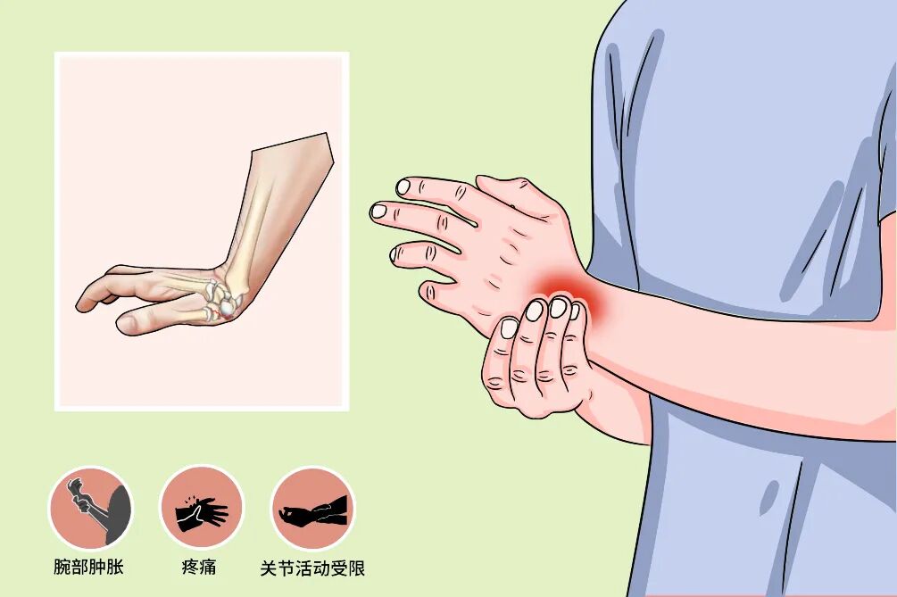 腕舟骨骨折治疗原则及康复指导 骨折