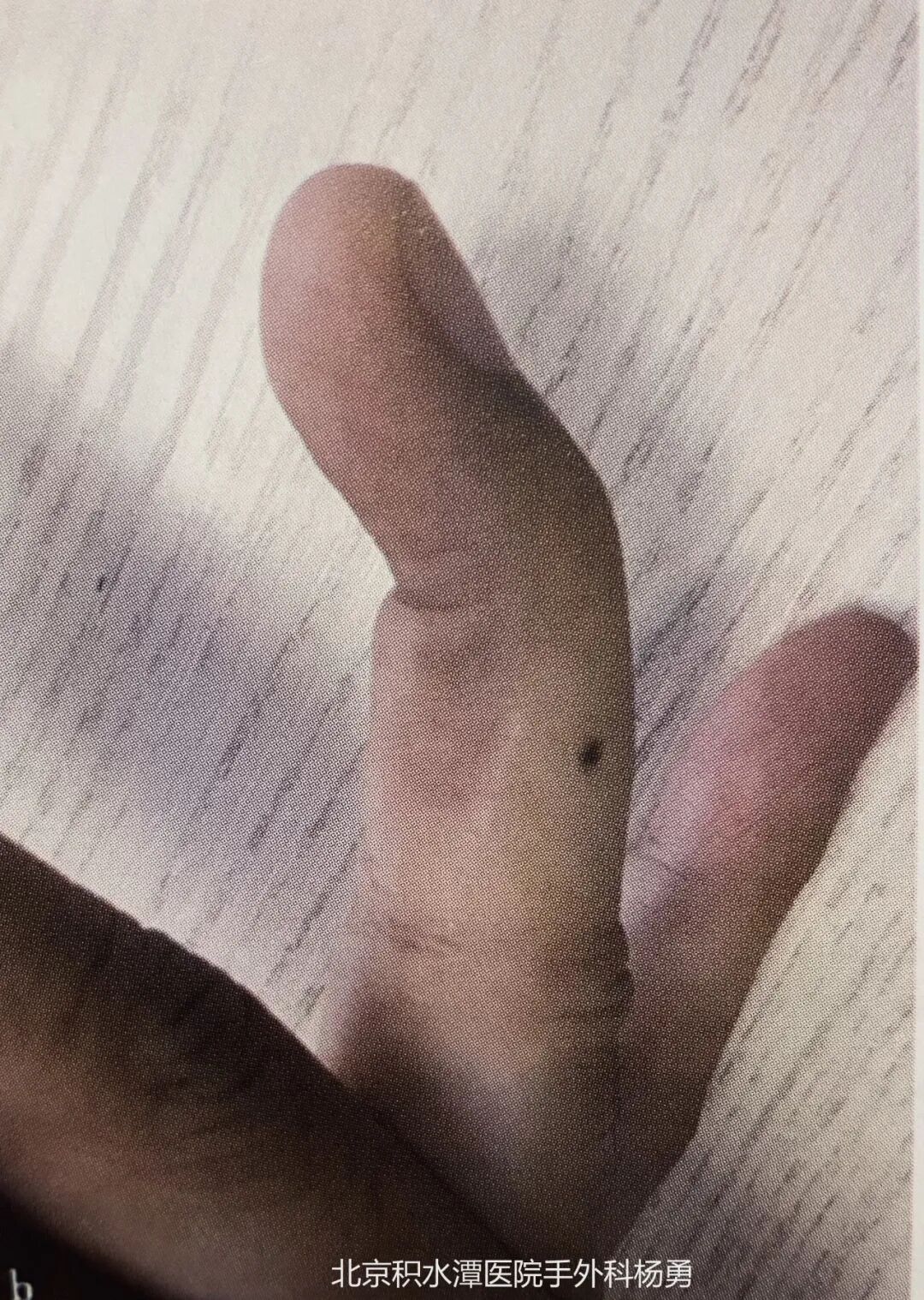 如患者未进行规范治疗,远期可能会继发"鹅颈畸形",对手指外观影响较大