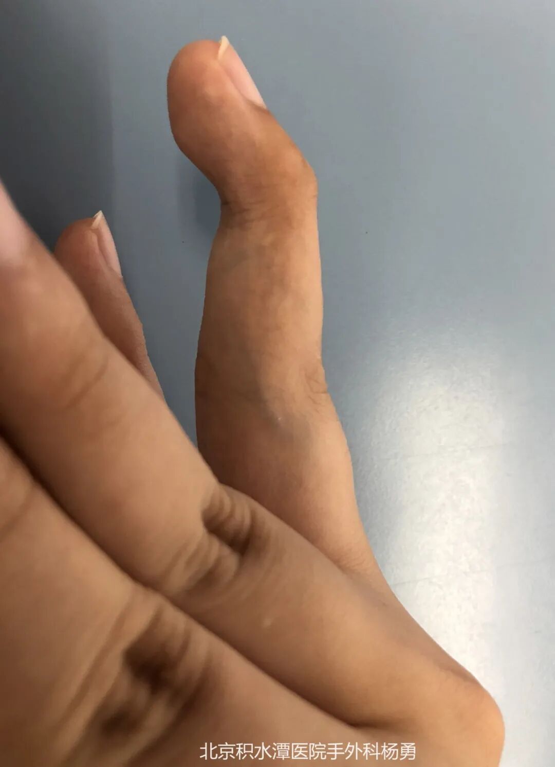 专家告诉您:"锤状指畸形"该如何治疗_先天性骨与关节畸形_先天性骨与
