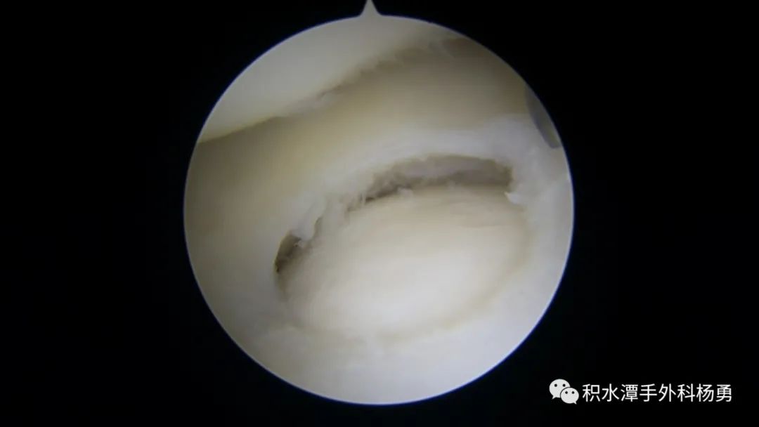 镜下检查能够发现tfc中央型损伤或穿孔,月骨或三角骨的软骨损伤等表现