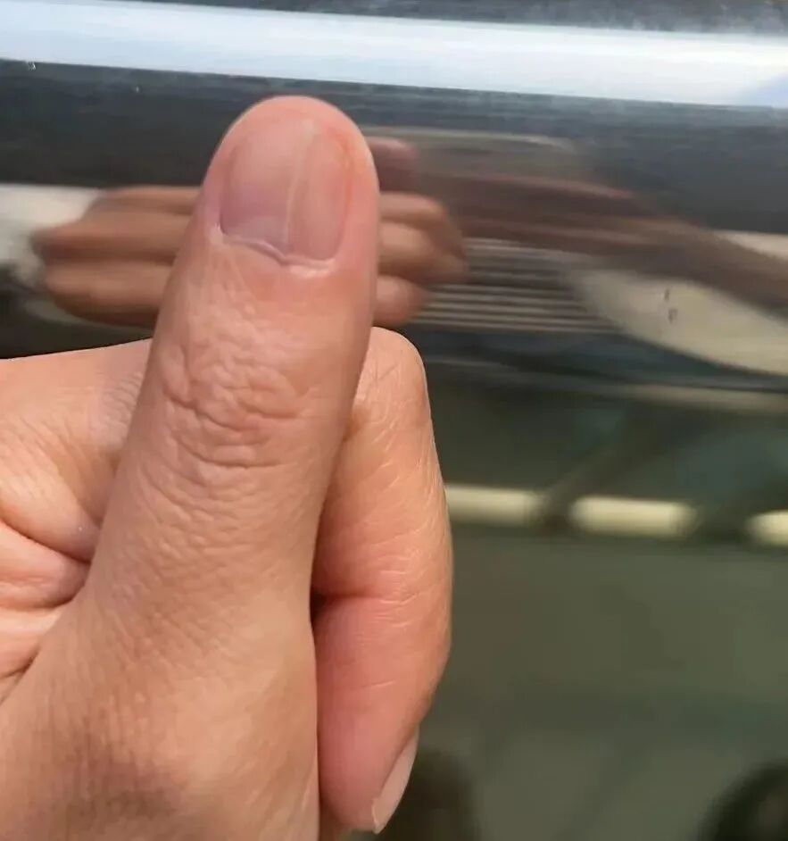 肌瘤钻怎么写手指钻心痛！市六院手足外科医生提醒当心“窝藏”甲下血管球瘤！_https://www.jmylbn.com_新闻资讯_第5张