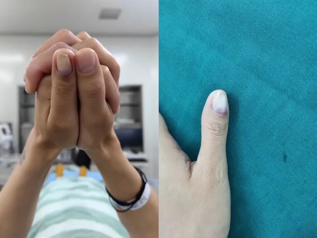 肌瘤钻怎么写手指钻心痛！市六院手足外科医生提醒当心“窝藏”甲下血管球瘤！_https://www.jmylbn.com_新闻资讯_第3张