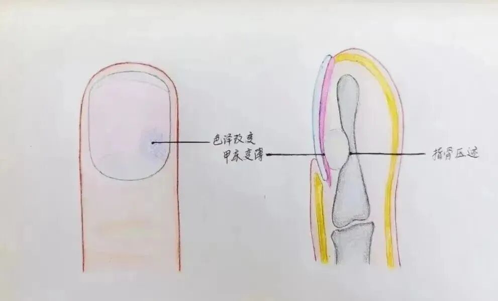 肌瘤钻怎么写手指钻心痛！市六院手足外科医生提醒当心“窝藏”甲下血管球瘤！_https://www.jmylbn.com_新闻资讯_第7张