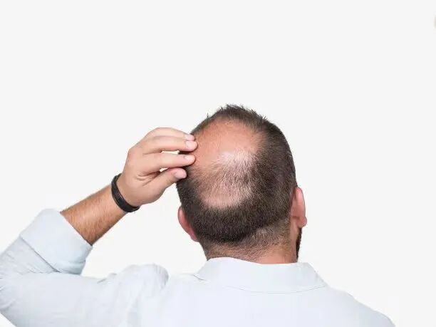 身体「缺」什么，会大把掉头发？