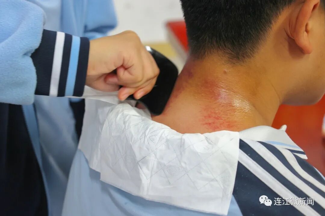针灸、拔罐……连江这群学生直接上手！