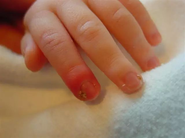 寶寶手指長倒刺，真的是缺乏維生素嗎？ 親子 第3張