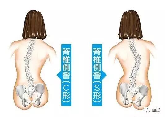 腰椎间盘突出症的自测