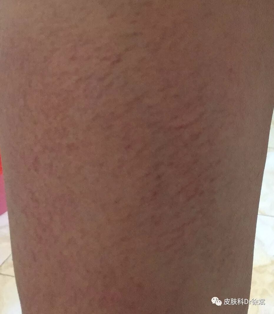 洗澡还能洗出干燥性湿疹 好大夫在线