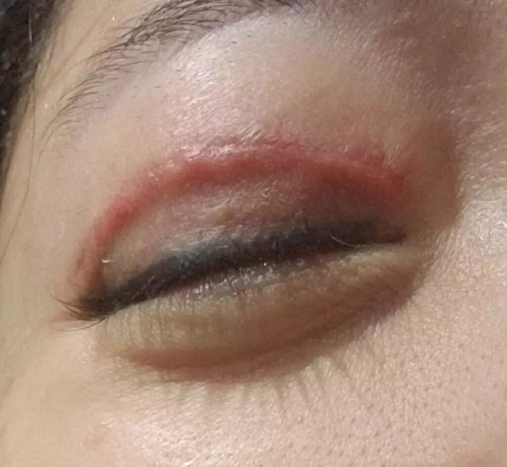 (术后三个月瘢痕增生爆发期)因此双眼皮手术后,肿胀是一个必经阶段