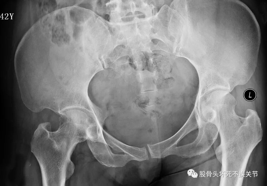 “恐龙蛋化石”：修炼成精的滑膜炎