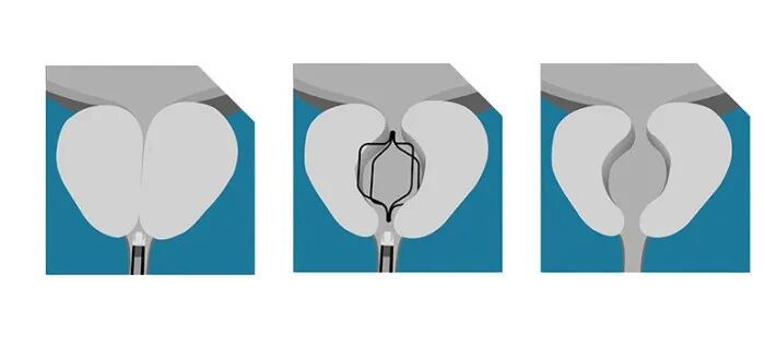 怎么前列腺器械获批FDA！前列腺微创植入器械_https://www.jmylbn.com_新闻资讯_第3张