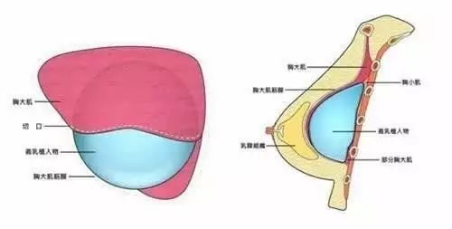 內窺鏡雙平面豐胸假體植入方式有什麼好?手感好就夠了