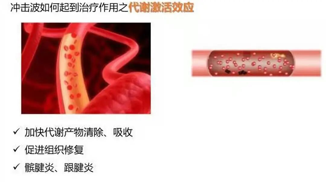 疼痛科怎么理疗三院疼痛科的理疗（一）——神秘的冲击波疗法_https://www.jmylbn.com_新闻资讯_第6张