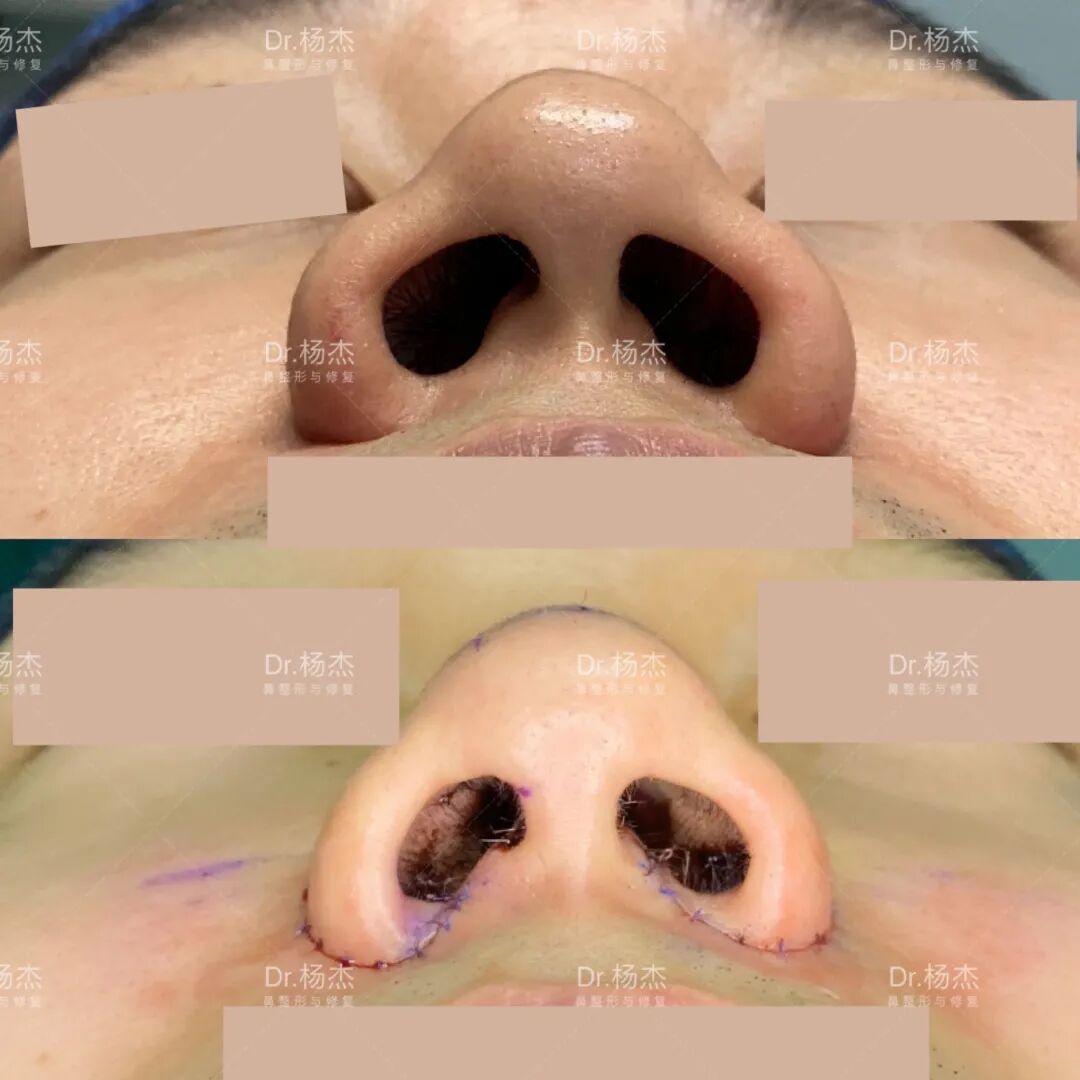 术后3月案例2:鼻翼内外鼻翼缩小,鼻槛缩小术案例3