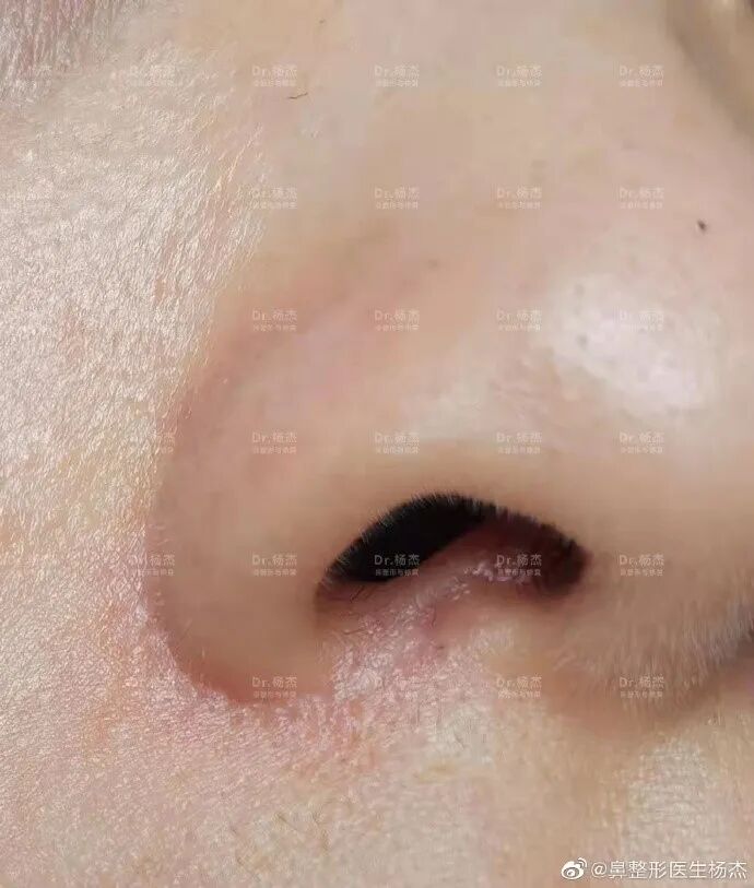 鼻槛整形之鼻槛下垂的治疗