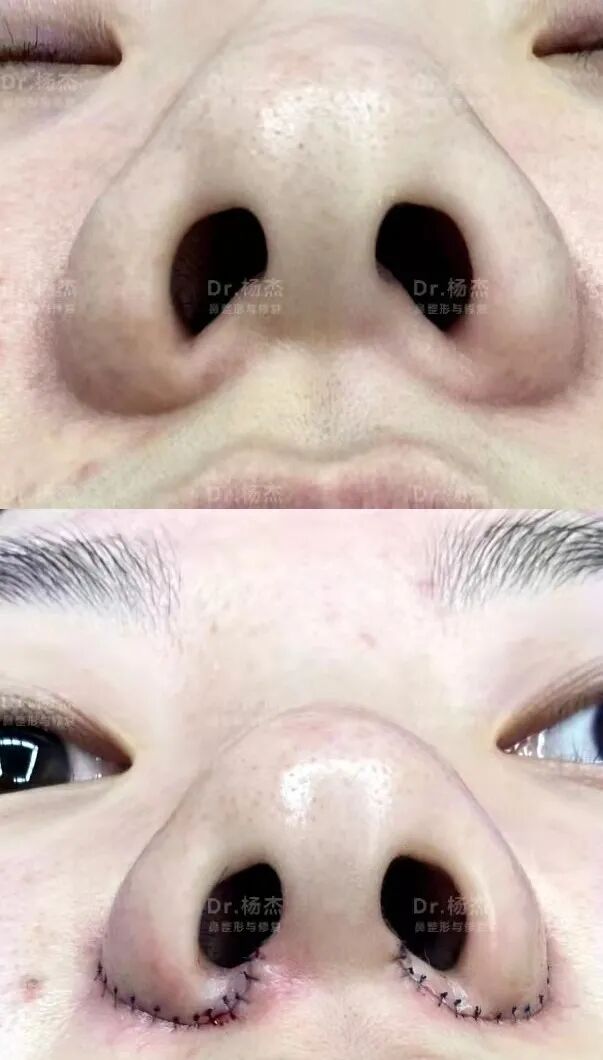 鼻槛整形之鼻槛缺损治疗-杨杰-爱问医生