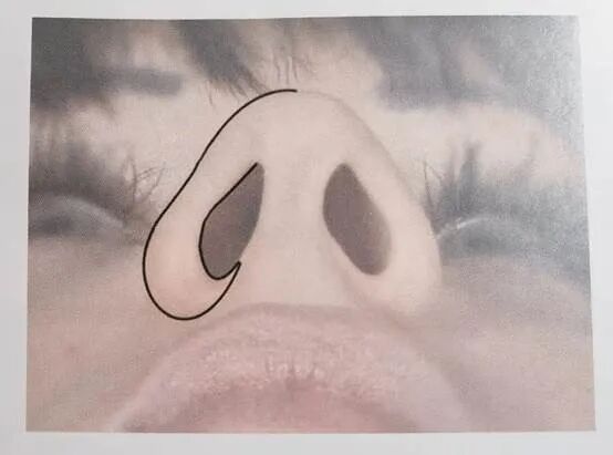 熟悉鼻槛美学形态及解剖结构,术中注意保护,做好预