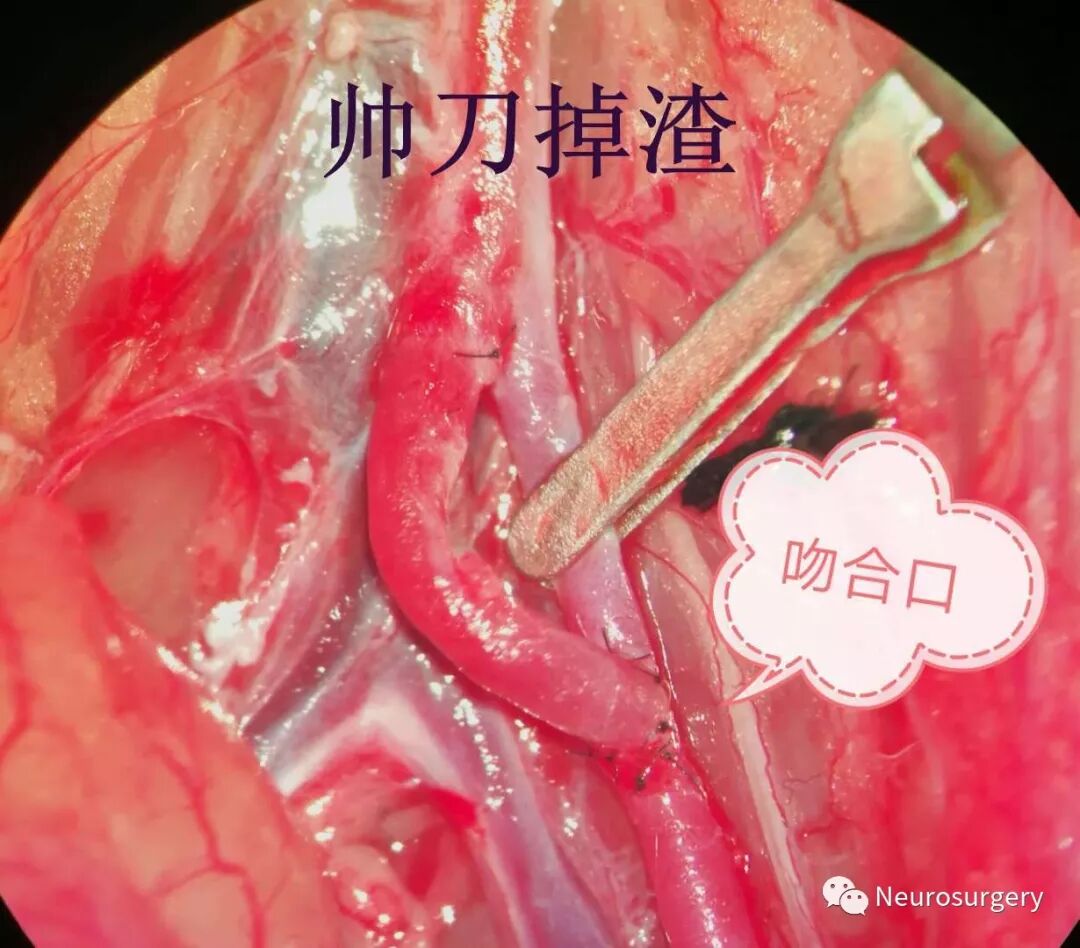 怎么区分显微剪刀医学科普：显微外科技术_https://www.jmylbn.com_新闻资讯_第25张