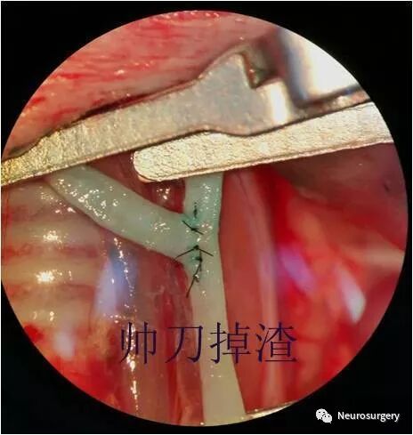 怎么区分显微剪刀医学科普：显微外科技术_https://www.jmylbn.com_新闻资讯_第24张