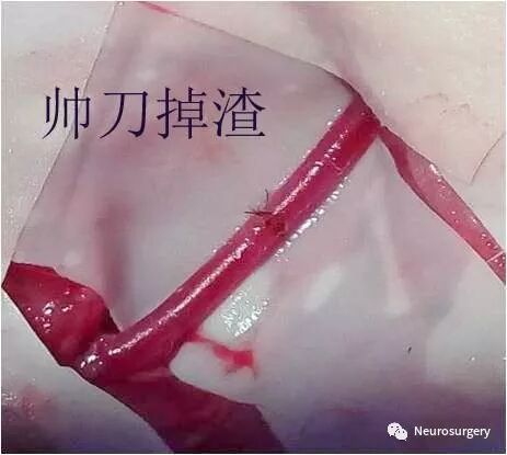 怎么区分显微剪刀医学科普：显微外科技术_https://www.jmylbn.com_新闻资讯_第22张