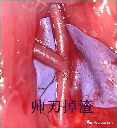 怎么区分显微剪刀医学科普：显微外科技术_https://www.jmylbn.com_新闻资讯_第23张