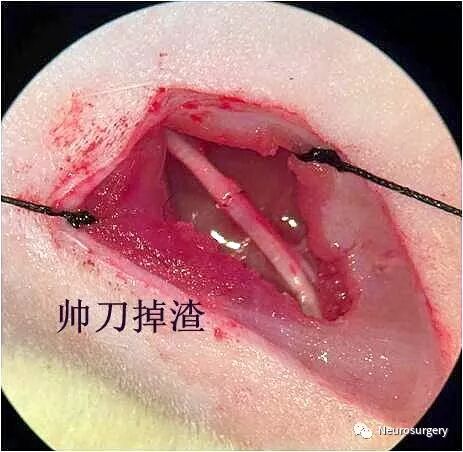 怎么区分显微剪刀医学科普：显微外科技术_https://www.jmylbn.com_新闻资讯_第26张