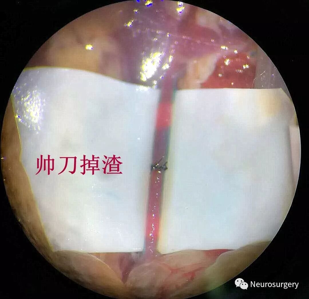 怎么区分显微剪刀医学科普：显微外科技术_https://www.jmylbn.com_新闻资讯_第27张