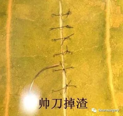 怎么区分显微剪刀医学科普：显微外科技术_https://www.jmylbn.com_新闻资讯_第17张