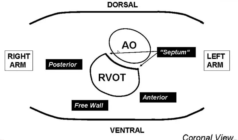 室性早搏的体表心电图定位