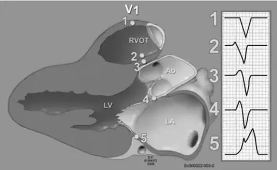 室性早搏的体表心电图定位