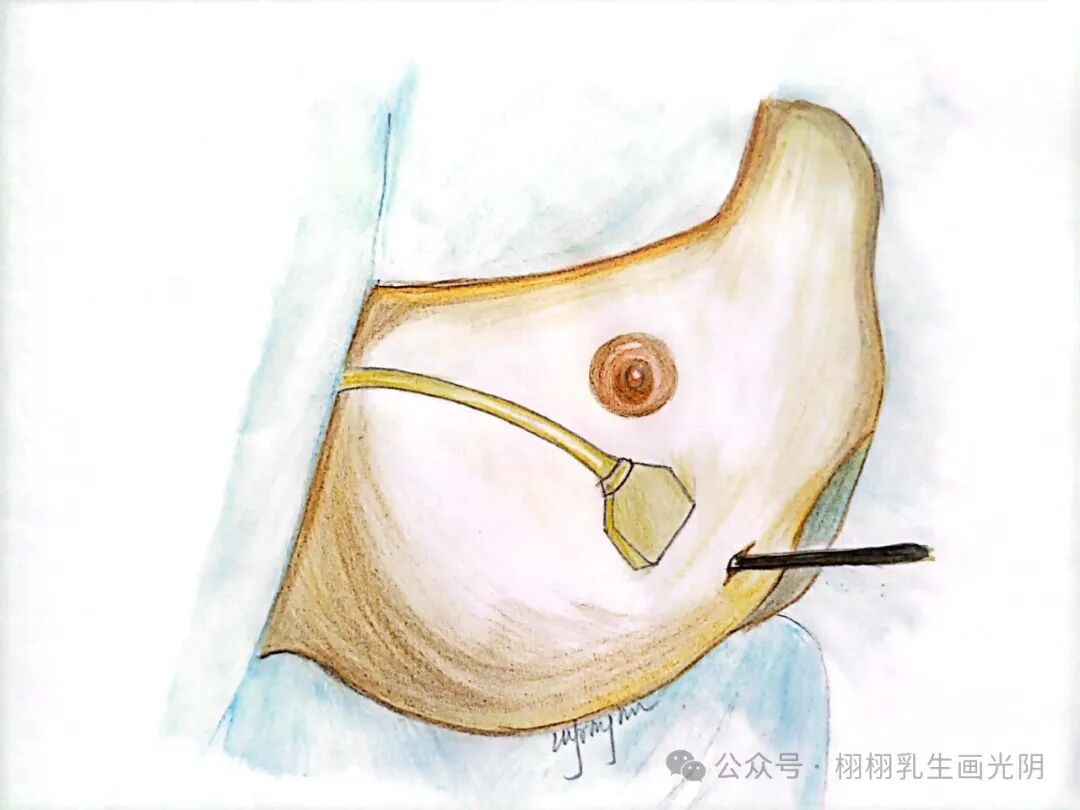 乳腺触诊成像怎么看乳腺检查全攻略：全方位守护乳腺健康_https://www.jmylbn.com_新闻资讯_第3张