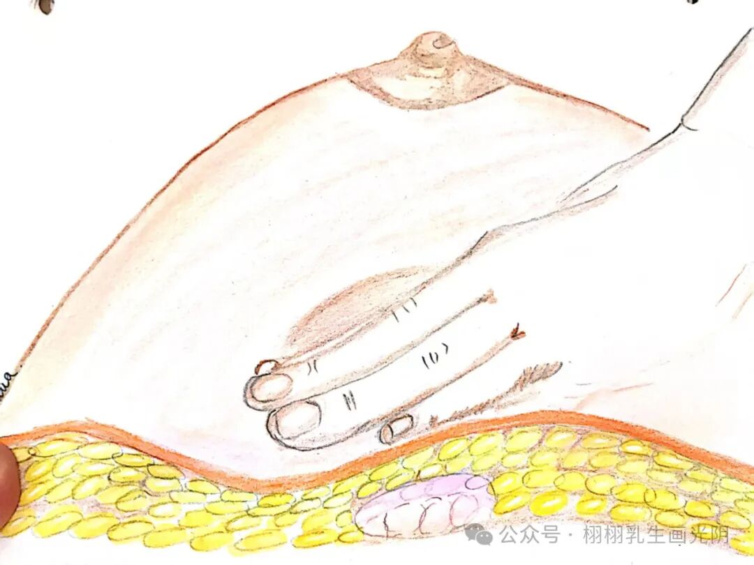 乳腺触诊成像怎么检查乳腺医生的手：触摸间的诊断智慧_https://www.jmylbn.com_新闻资讯_第1张