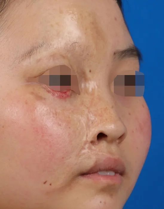 幼时不幸半面毁容，整形修复绽放新颜