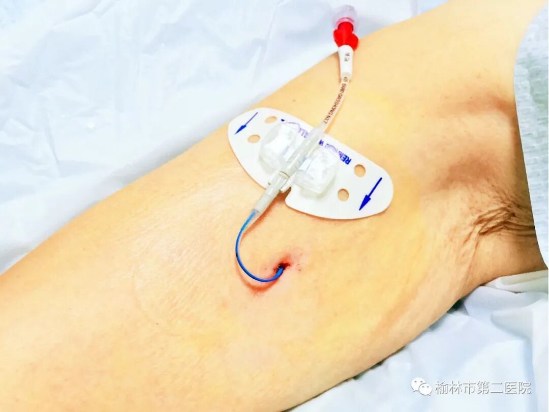 据了解,picc是由外周静脉置入,导管尖端定位在中心静脉的深静脉置管