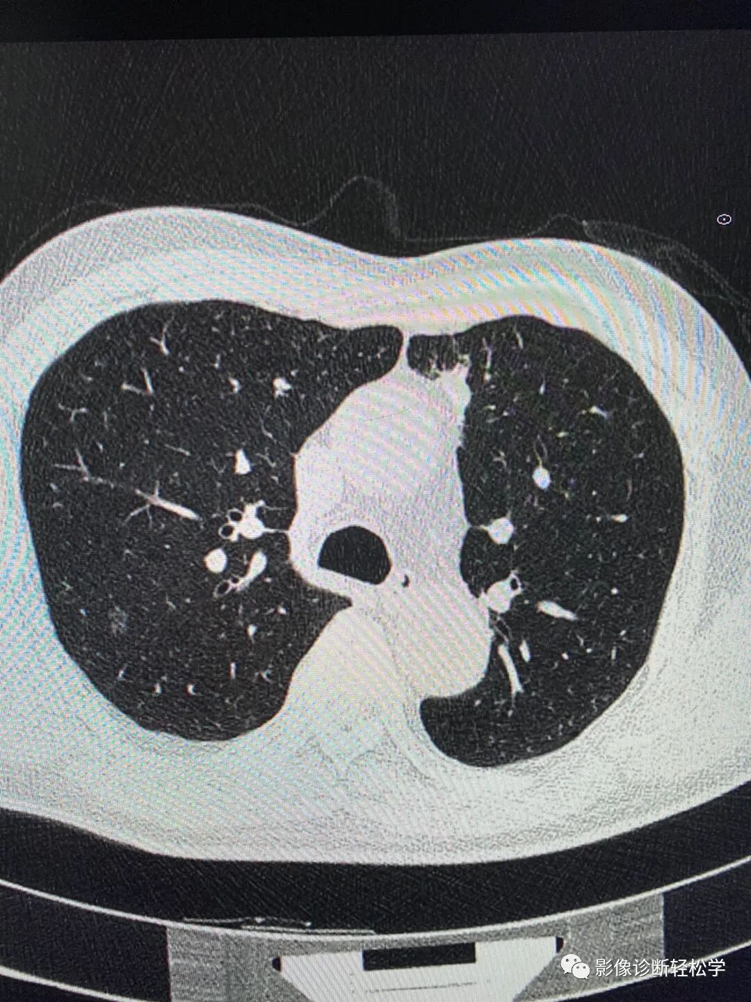 一个6mm的磨玻璃结节任其发展三年后怎么样了