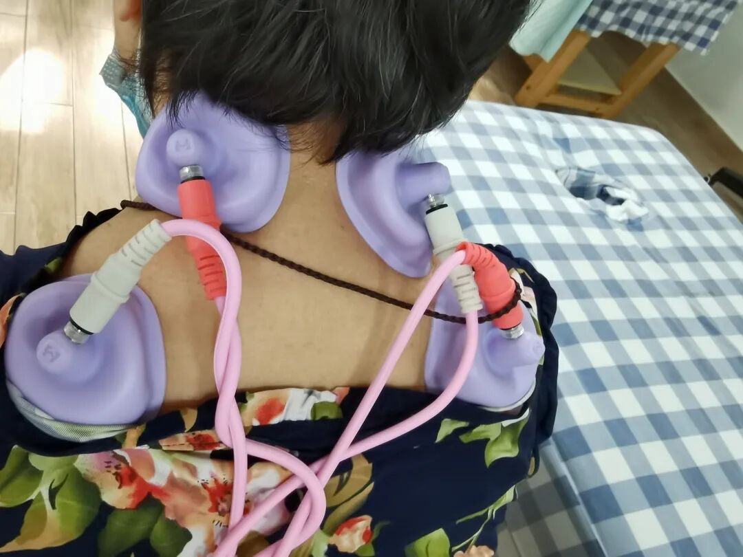干扰治疗仪怎么使用【康复学术】颈肩腰腿痛治疗神器——干扰电治疗仪_https://www.jmylbn.com_新闻资讯_第14张