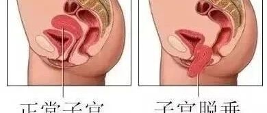 为什么你的子宫“掉”下来了?