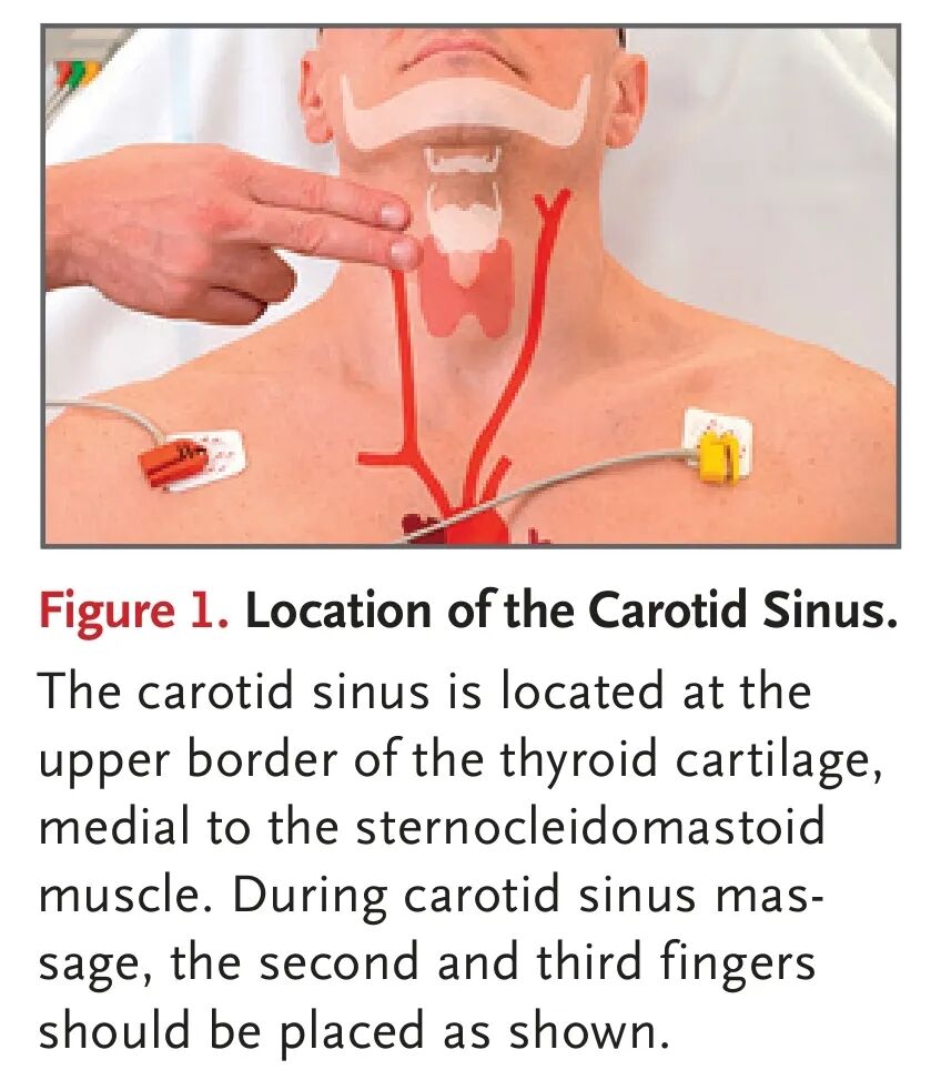 您会做颈动脉窦按摩吗