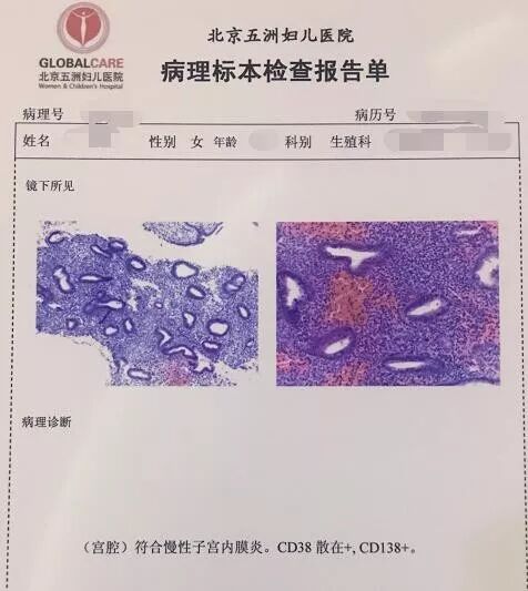 人流刮匙有什么型号不明原因不孕、流产，你做子宫内膜活检了吗？_https://www.jmylbn.com_新闻资讯_第3张