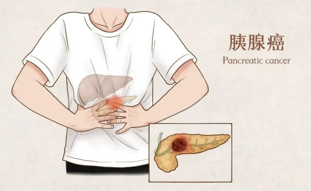 「本周六晚直播」胰腺癌早期症状不明显，错过最佳治疗时机怎么办？听听专家的建议！