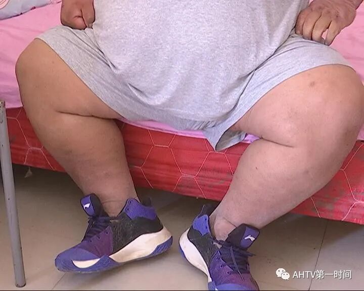 减肥手术有什么危害_手术减肥_减肥手术有哪些方法