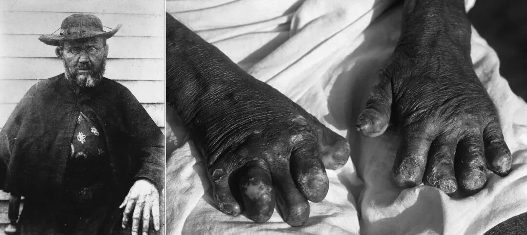 人们带给它们麻风病再把它们吃掉