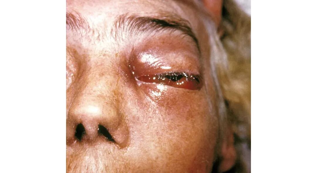 毛霉病患者.图片:cdc/dr. thomas f.