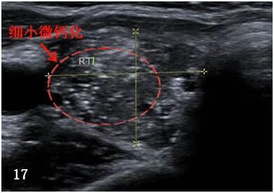 2*8mm甲状腺结节_甲状腺结节8mm大吗_甲状腺结节8mm