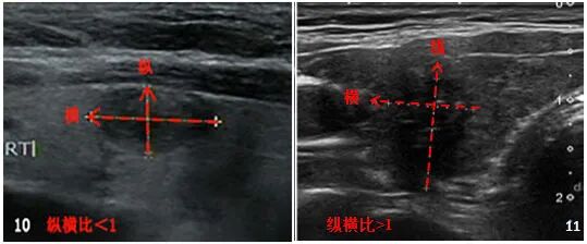 甲状腺结节8mm大吗_甲状腺结节8mm_2*8mm甲状腺结节