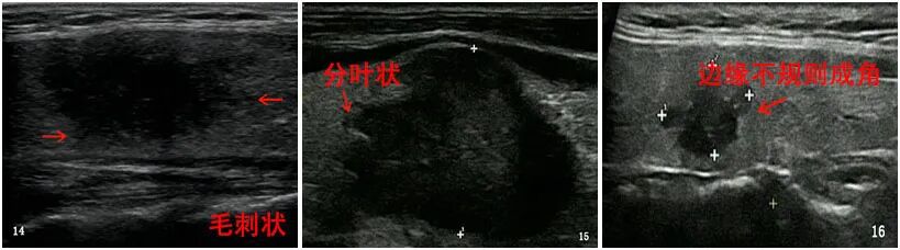2*8mm甲状腺结节_甲状腺结节8mm大吗_甲状腺结节8mm