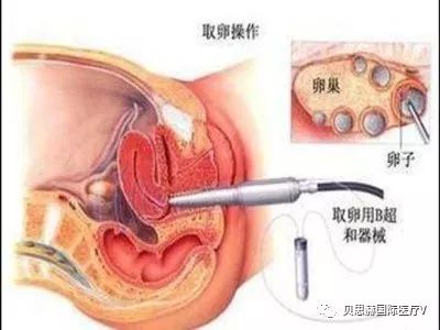 试管婴儿取卵有多痛 试管婴儿移植要多久 贝思赫国际医疗v 微信公众号文章阅读 Wemp