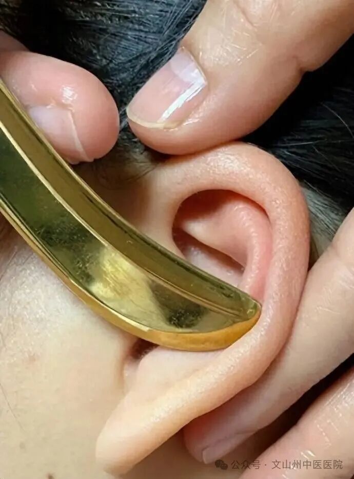 中西医结合疗法，突破突发性耳聋护理难题荣获省级奖项，彰显中西医结合护理创新实力(图4)